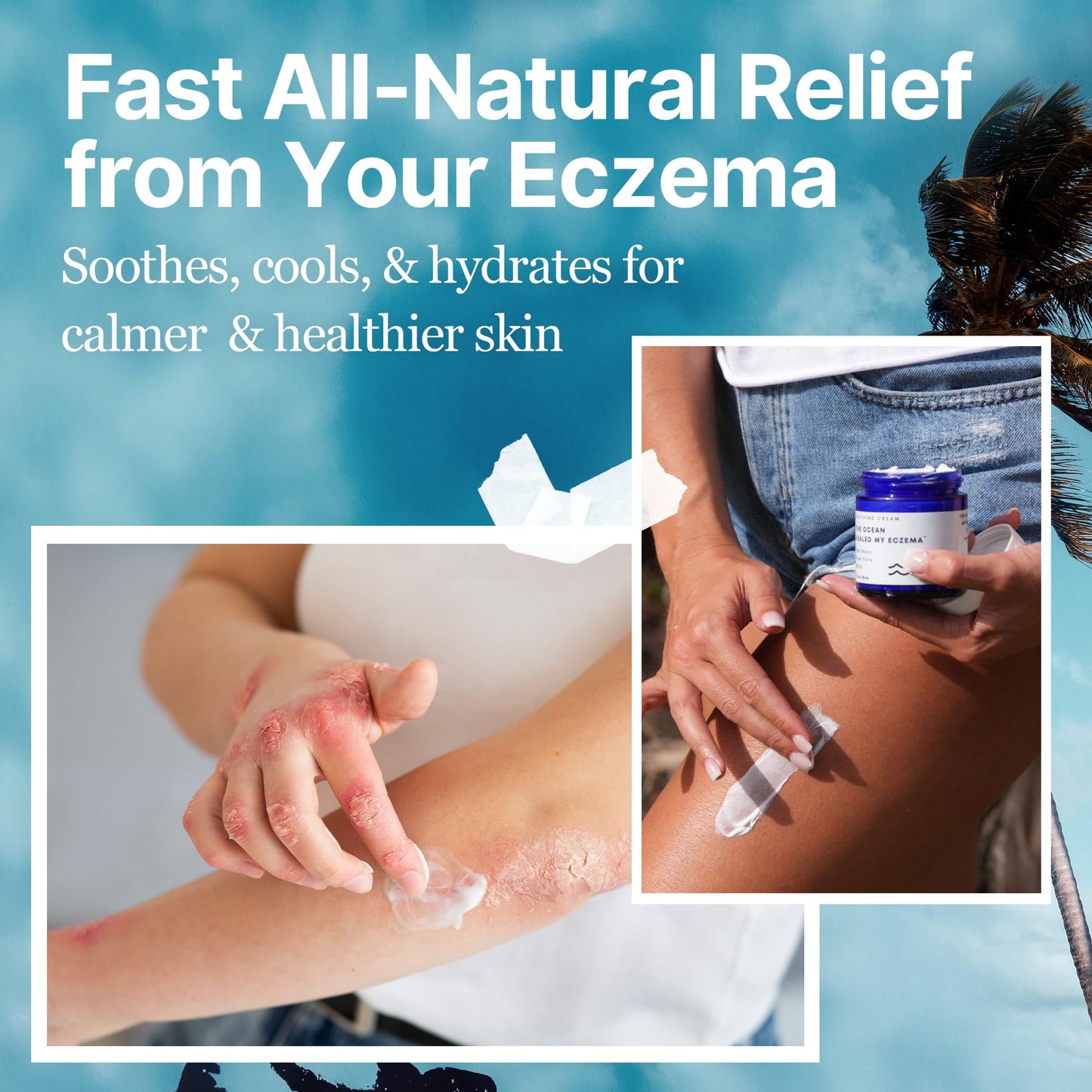 The Ocean Healed My Eczema Natural & Soothing Eczema Cream